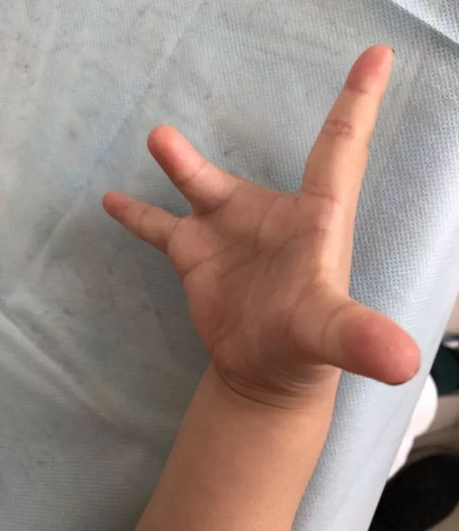我院手外科医生查体发现,宝宝右手外观畸形,中指缺失,第3掌骨短小