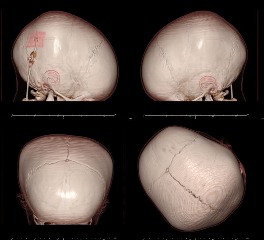 图2. 患儿头颅三维ct检查.