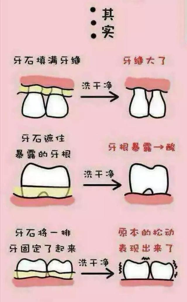 误区3:洗牙会把牙缝洗大,牙齿洗松动,洗完牙还容易塞东西