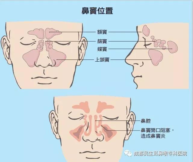 不想动手术的鼻窦炎咋个治?