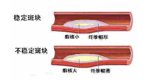 另外,不稳定斑块在出现心脑血管事件之前都会有一些小的症状提示血管