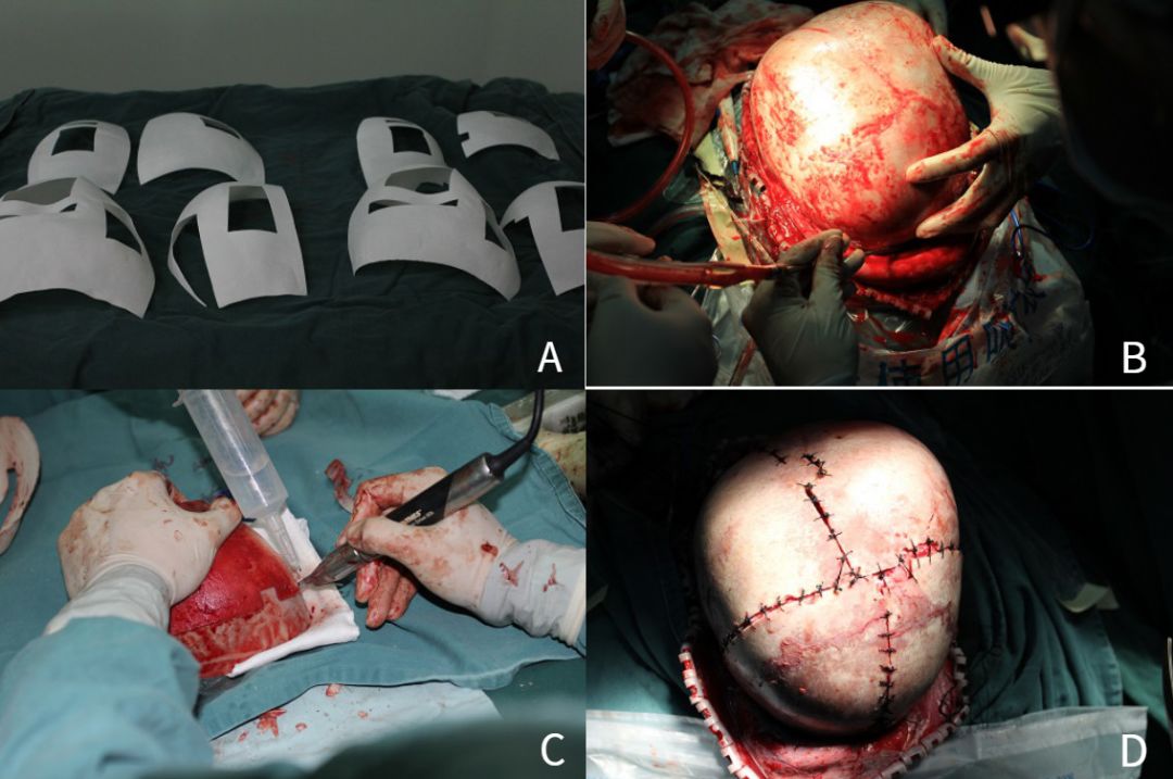 图5. a手术3d导板; b全头颅暴露; c切割颅骨;d 颅骨重拼.