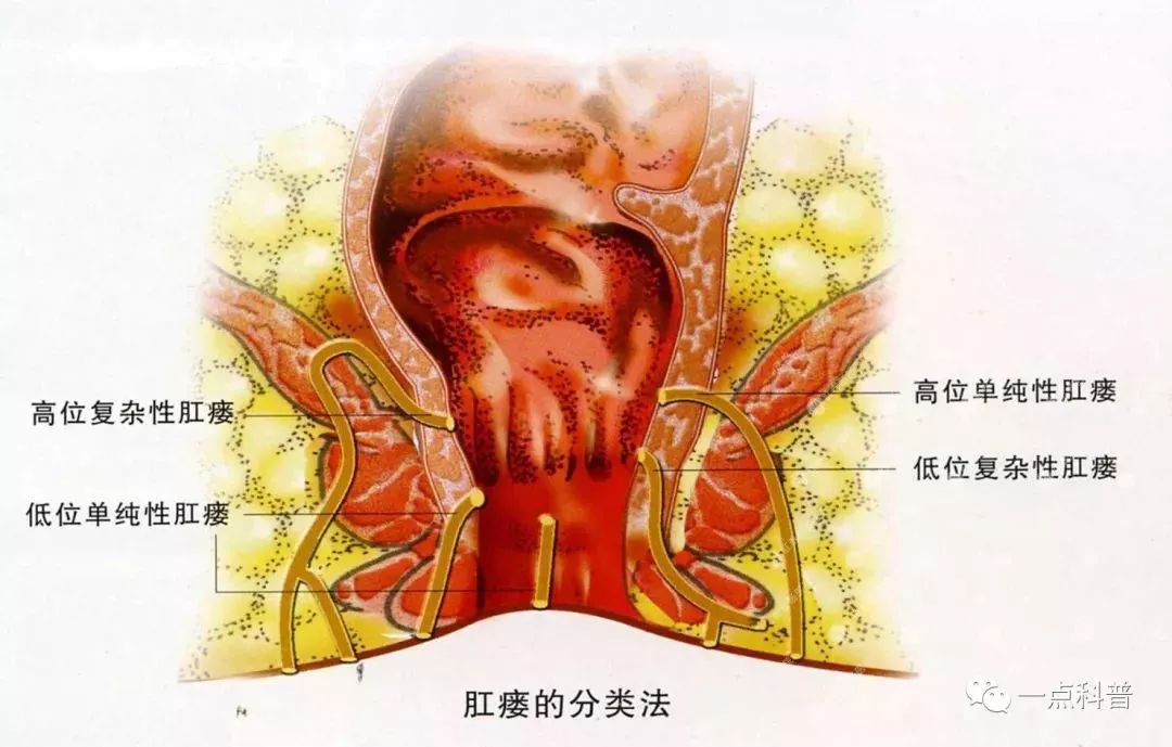 肛门周围的"囊肿"不一定就是粉瘤, 还可能是肛瘘啊!