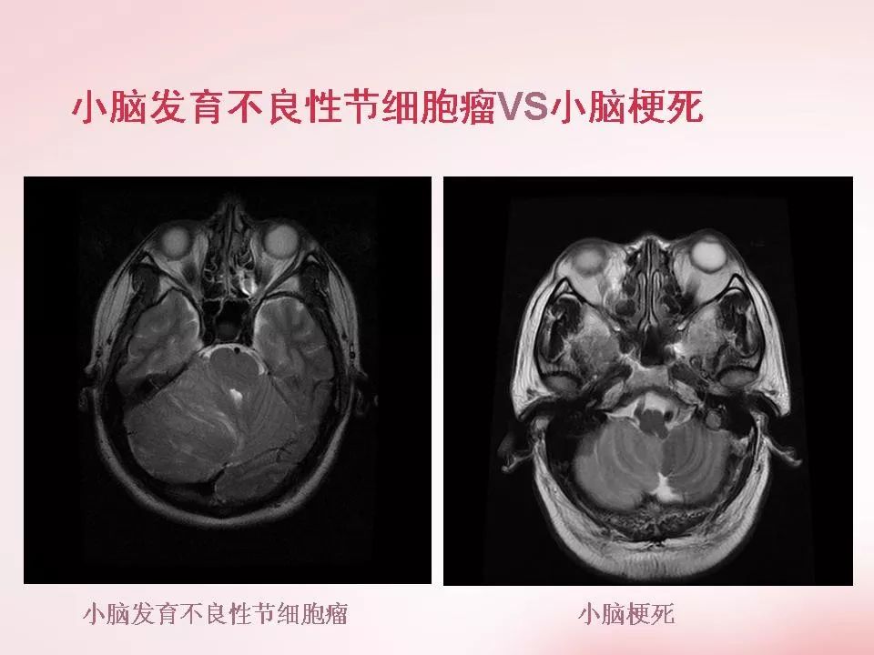 小脑发育不良性节细胞瘤的mr诊断影像天地