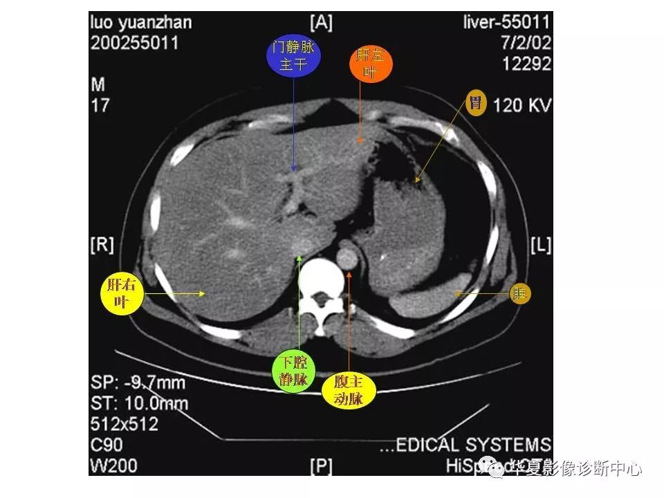 影像基础腹部ct断层解剖