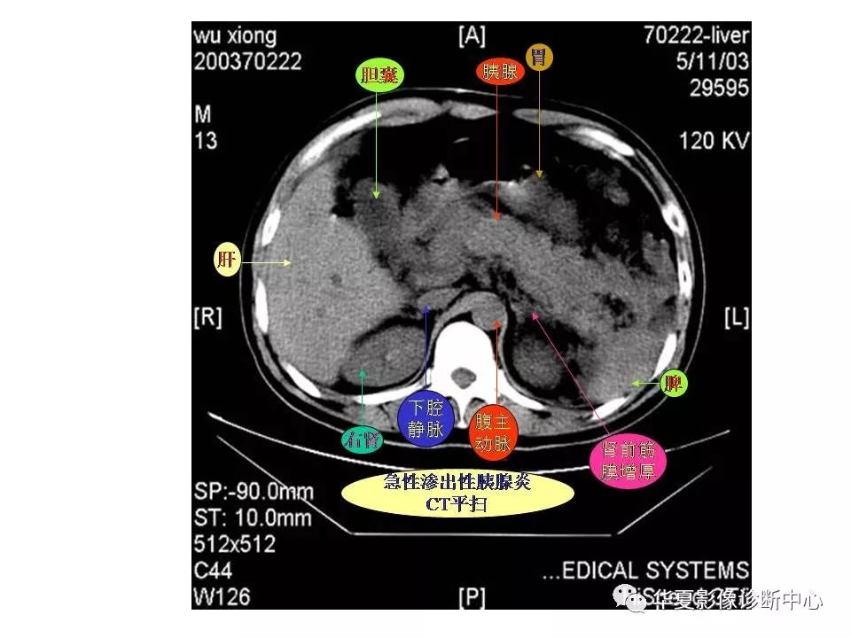 影像基础腹部ct断层解剖