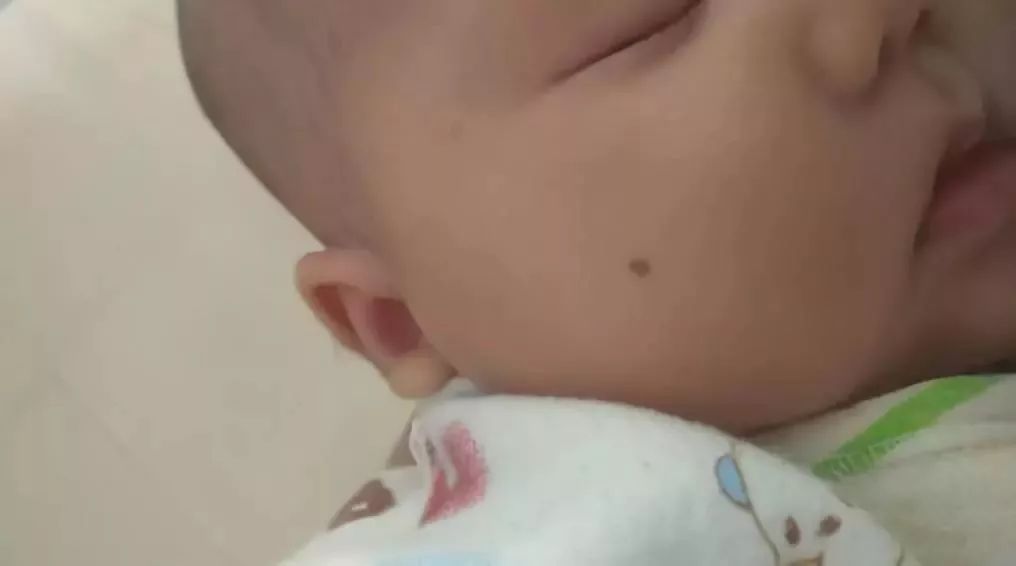                     这几种胎记不及时处理会要命，家长越早带孩子去医院越好