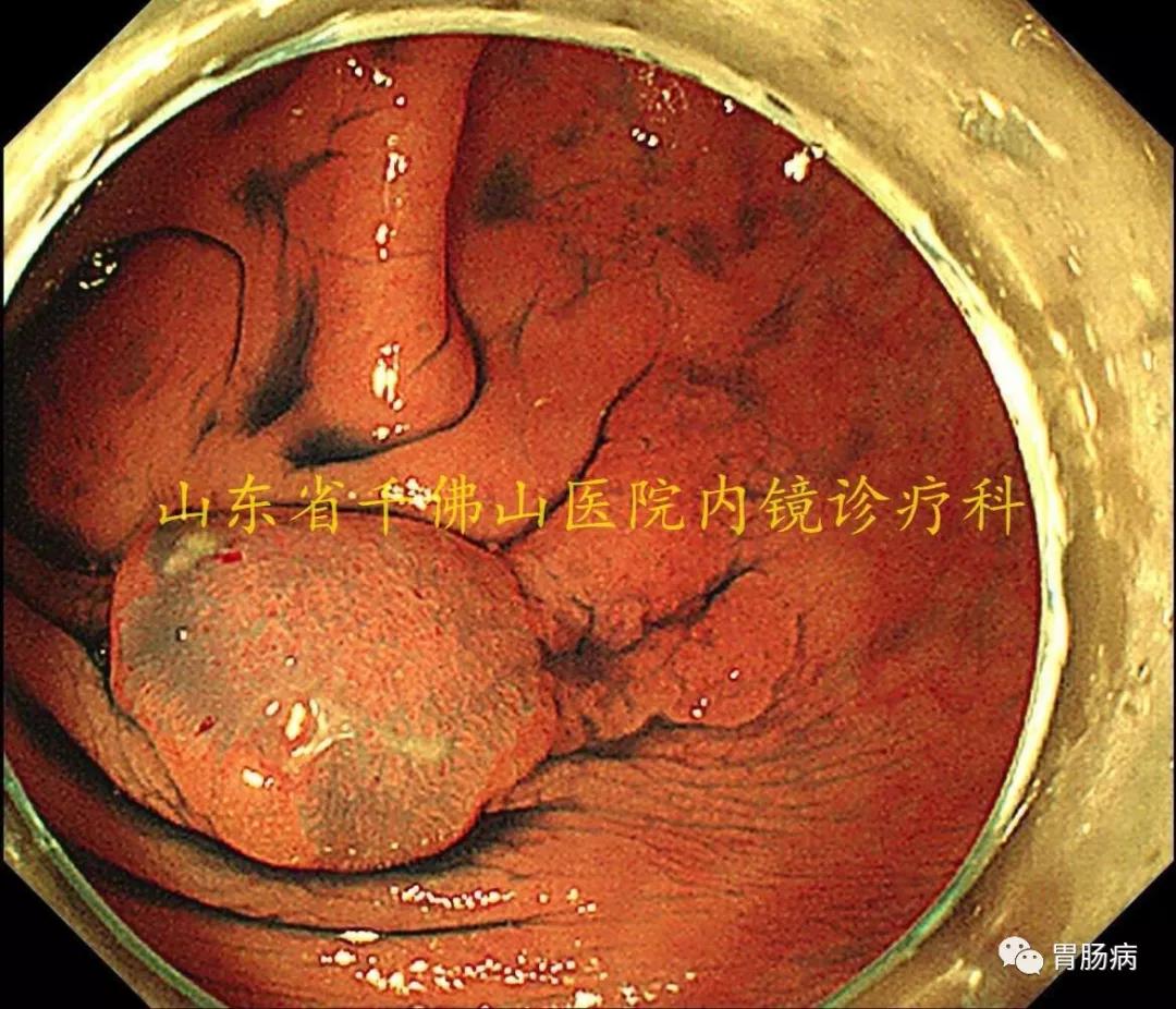 会遗传的大肠癌——林奇综合征