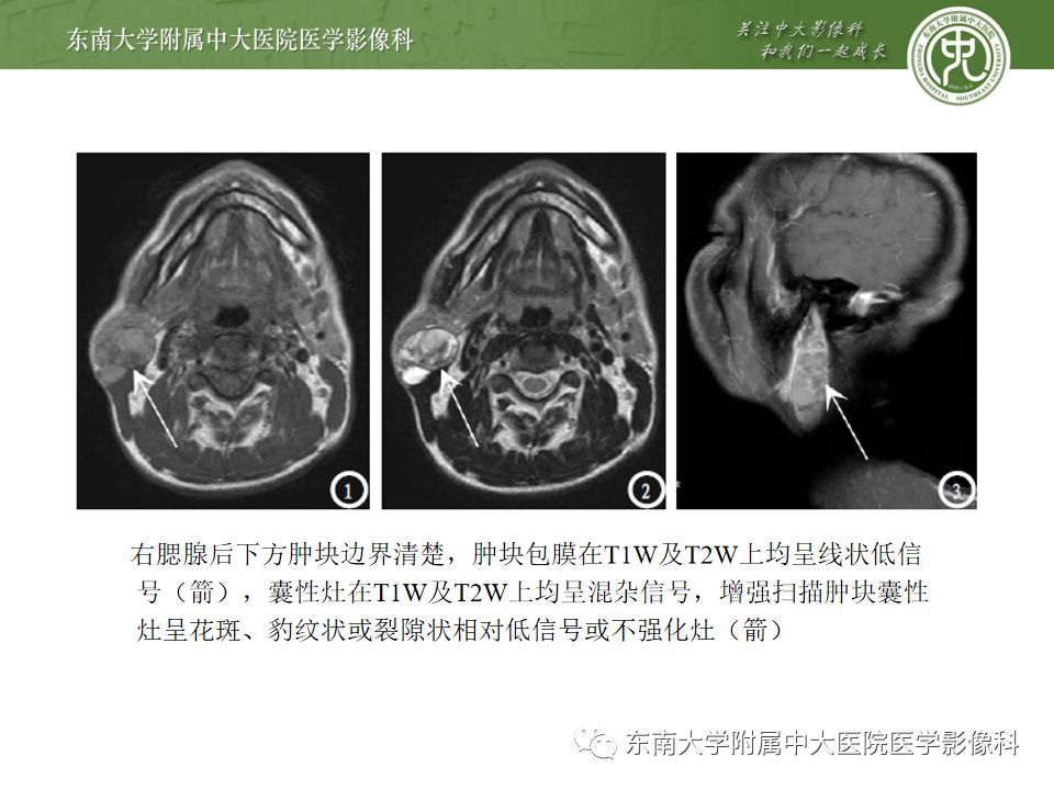 精彩推荐 | 腮腺淋巴上皮囊肿影像表现及鉴别