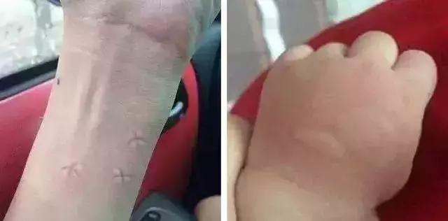                     一个蚊子包竟让3岁宝宝全身瘫痪，这些防蚊措施无效还有害！别再用了！