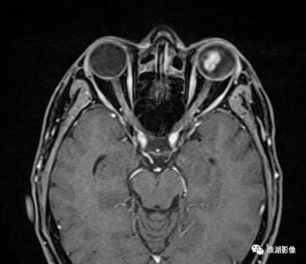 中级病例 | 脉络膜黑色素瘤影像表现