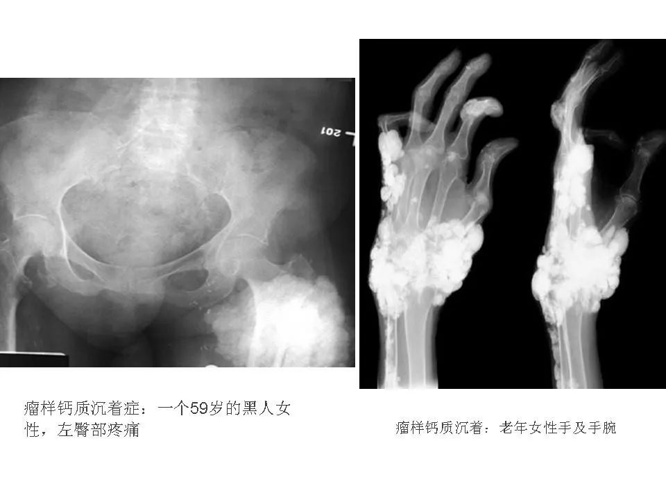 肿瘤性钙盐沉积症 | 影像天地