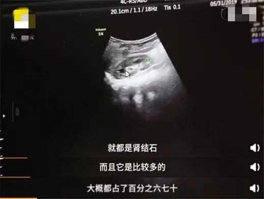                     原创            妈妈一个错误观念，致9个月大宝宝肾脏60％都是肾结石