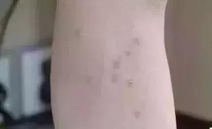                     一个蚊子包竟让3岁宝宝全身瘫痪，这些防蚊措施无效还有害！别再用了！