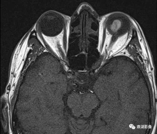 中级病例 | 脉络膜黑色素瘤影像表现