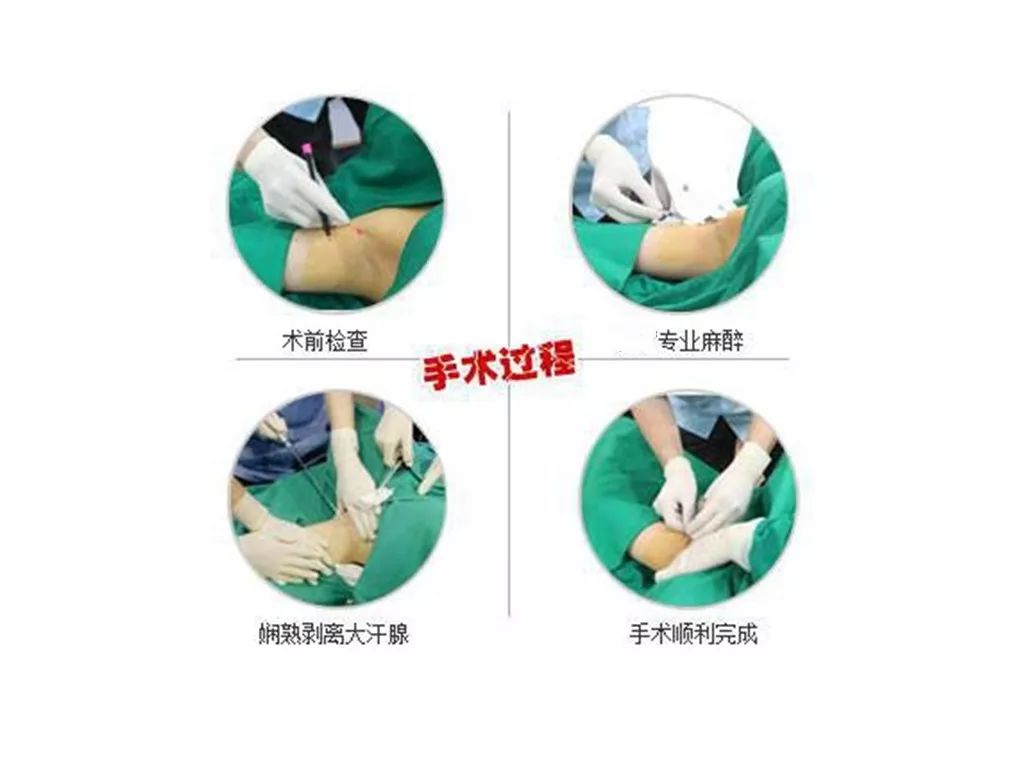 腋臭"一针"搞定,给你清凉一夏!