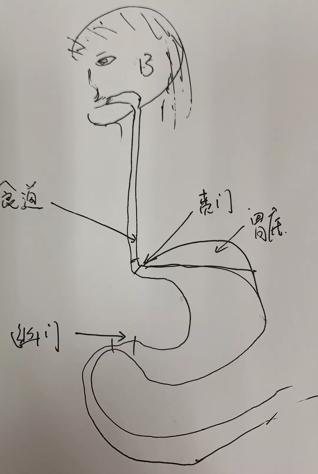 为了让小七理解贲门的位置,贴心的张医生手绘了这张图把贲门撕裂治好