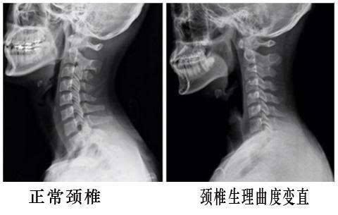 脖子直了怎么办