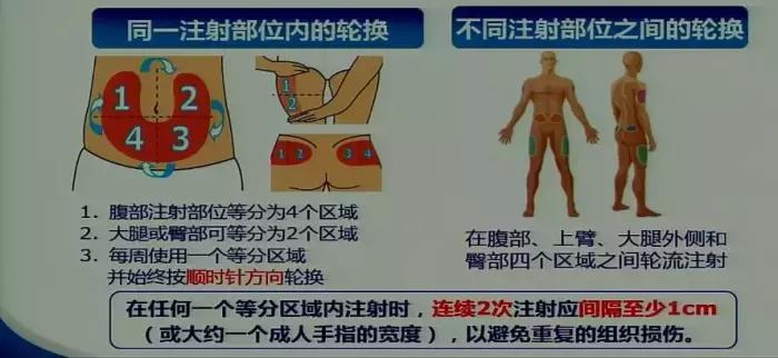 6)正确轮换注射部位,可有效预防局部硬结和皮下脂肪增生