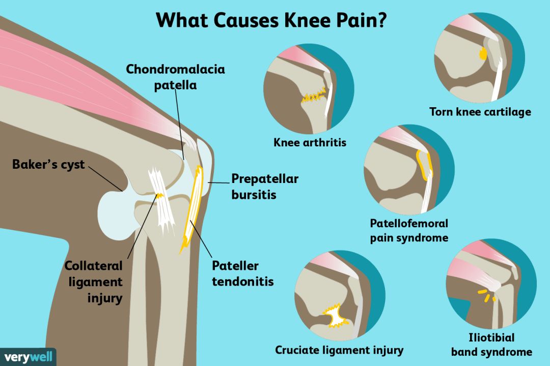 How Does Fluid In Knee Go Away at Harry Williams blog