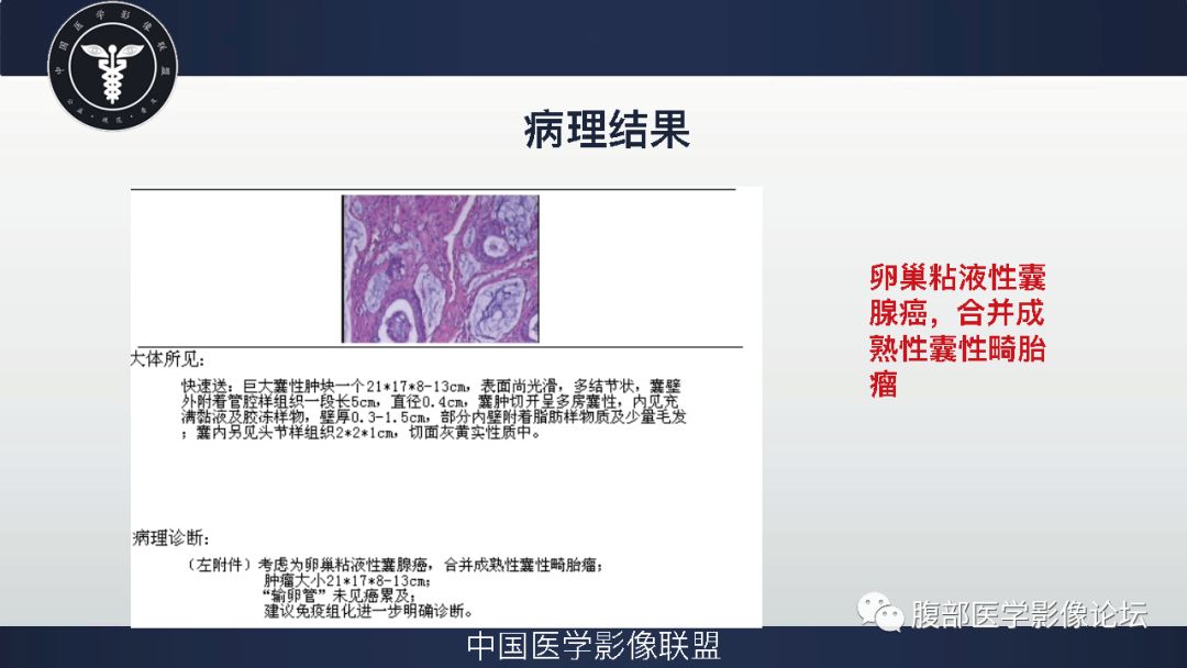 卵巢粘液性囊腺癌