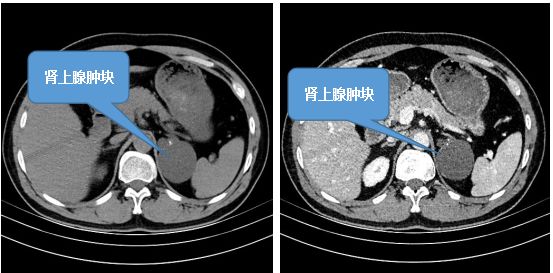 麻阳县中医医院再次成功完成肾上腺肿瘤切除手术
