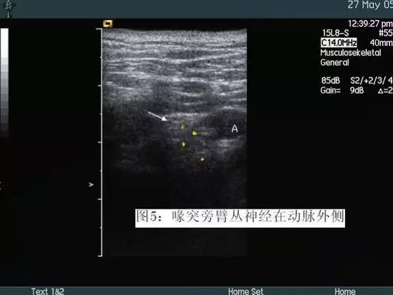 超声引导下的臂丛神经阻滞