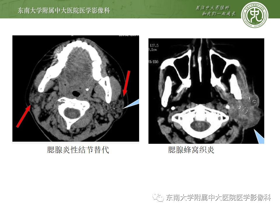 精彩推荐 | 腮腺淋巴上皮囊肿影像表现及鉴别