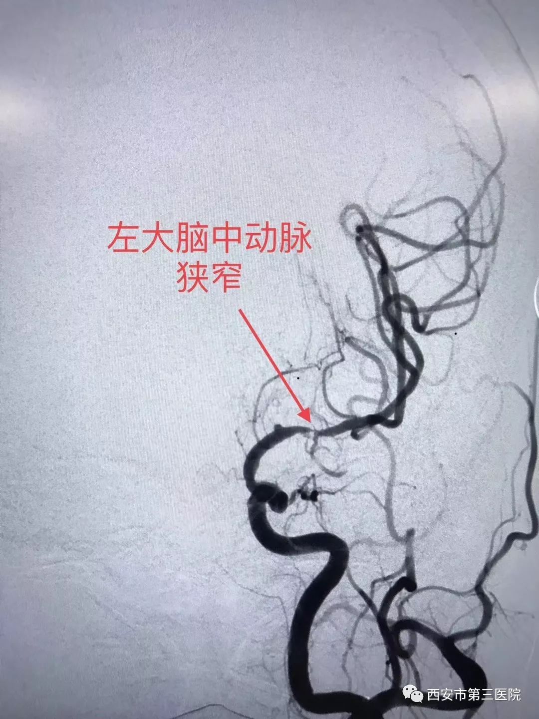 【精准诊治】一例进展性脑梗死颅内动脉支架植入术