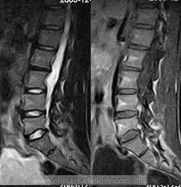 表皮样囊肿腰椎管等你分析读片专栏1106期