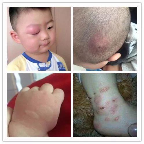                     我们试了100种宝宝防蚊大法，最管用的竟然是这3招