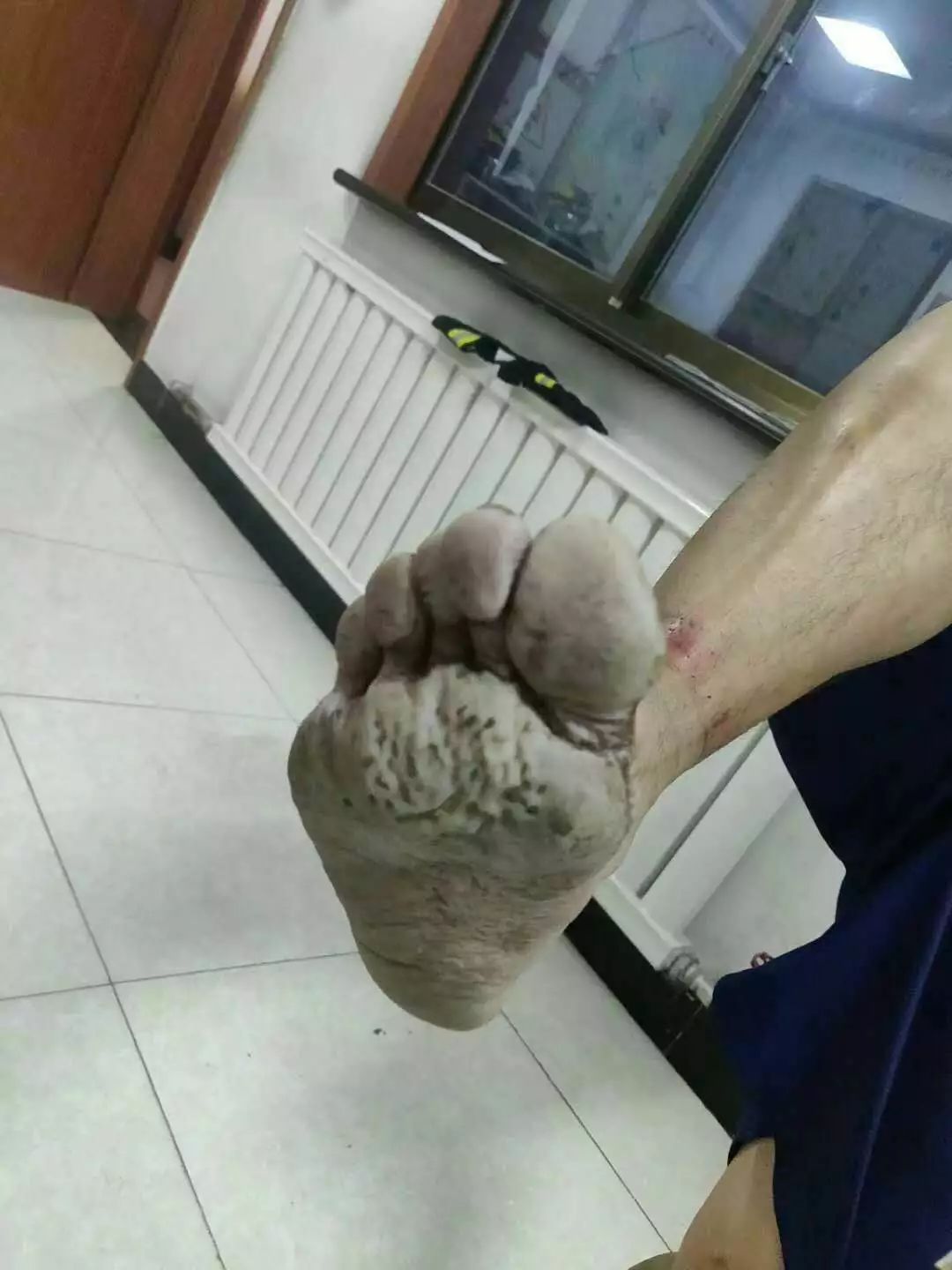 有人说这只脚是百岁老人的脚,其实这只脚的主人年仅20岁,他的脚之所以