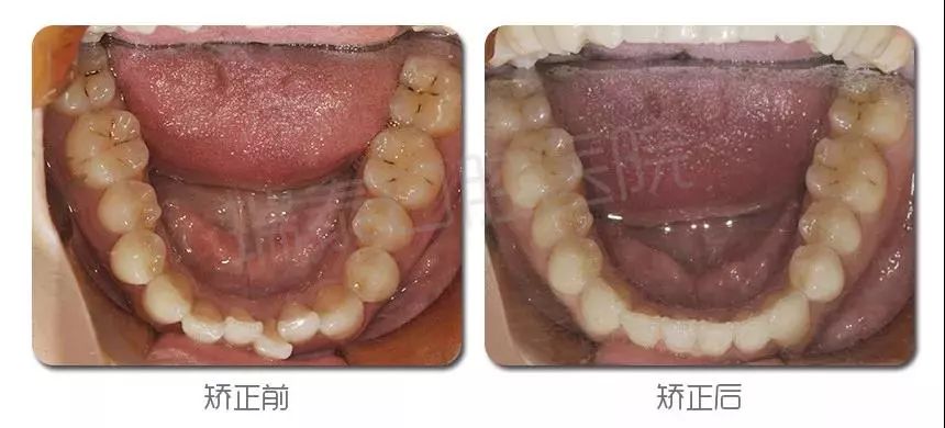 亚奥人牙齿矫正终于降价了!更有洁牙卡,洁面仪免费送!