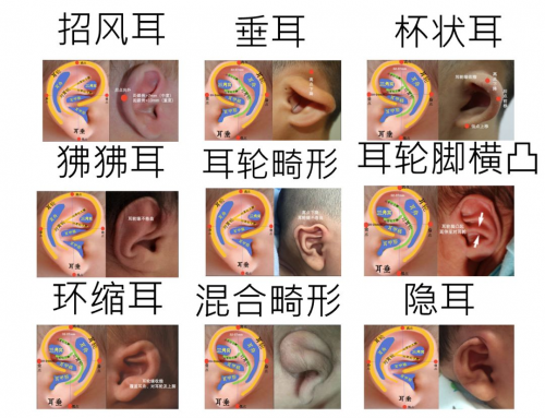 外耳畸形的几种病症小常识