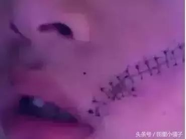                     因为一罐冰可乐，6岁男孩被缝38针！这件危险事很多厦门人还不以为然...