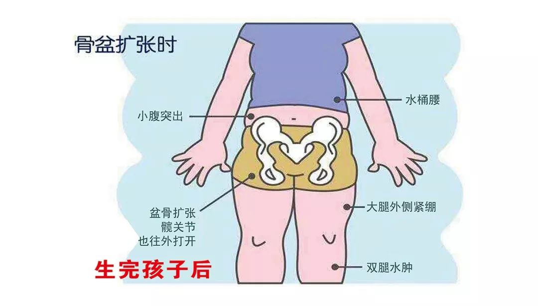 骨盆人口右倾斜经_骨盆倾斜图片(2)