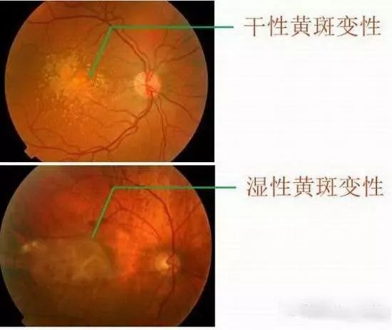 干性黄斑变性是由于黄斑上的细胞逐渐受损而引起的,并导致中央视力