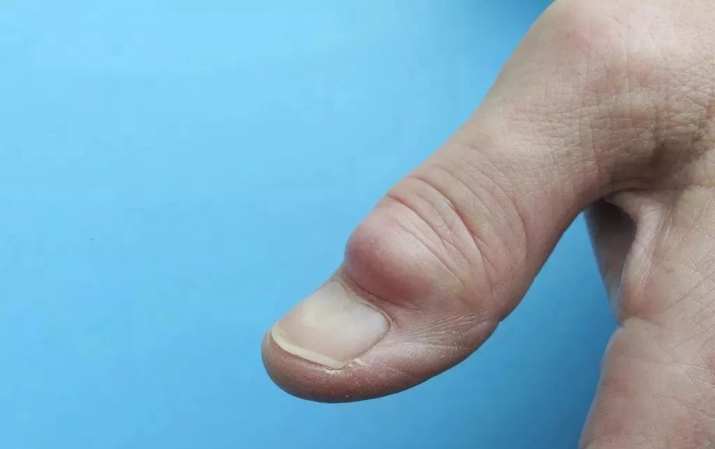 一个长在手指上的囊肿