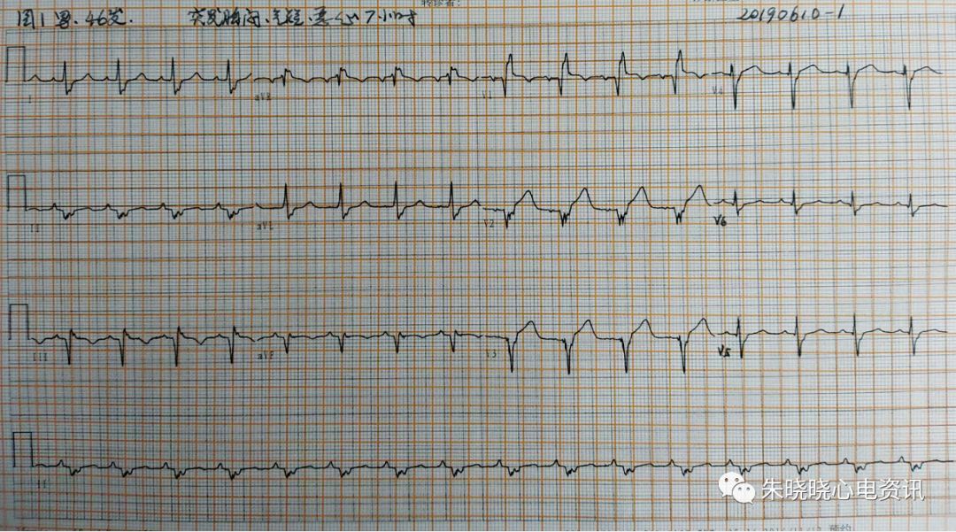 卢老师看心电图 -- 急性前间壁及前壁心肌梗死 2019-6