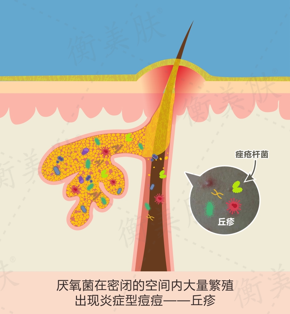 代谢垃圾及细菌撑大胀裂皮脂腺,导致周围其它皮脂腺感染细菌,丘疹加重