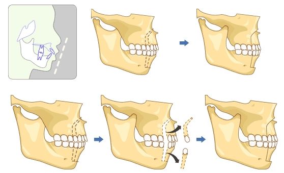为什么很多人都选择暑假做牙齿矫正?