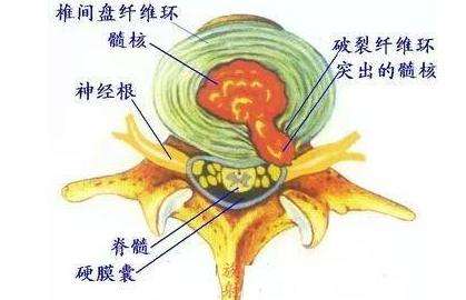 右腰疼怎么办