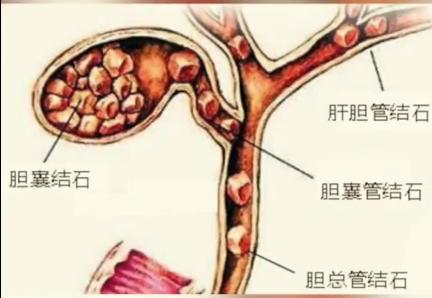 女子手术取出7750颗胆结石!看看你平时有没有这样的坏