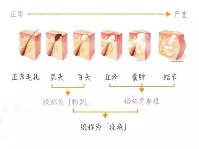 痘痘 我们通常说的痘痘是指闭口粉刺,黑头,以及感染痘痘细菌(痤疮丙酸