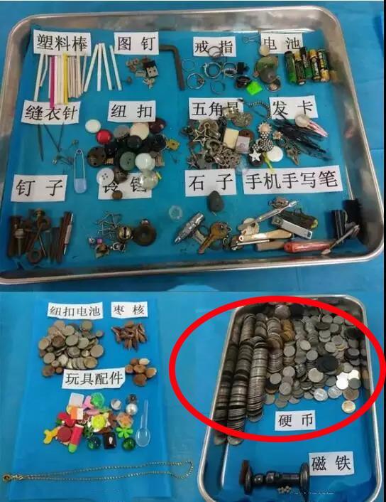                    原创            一岁宝宝误吞纽扣电池，送急诊后食管已感染，这张照片值得反省