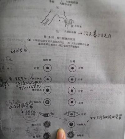 未应用扩瞳剂患者瞳孔散大,这是什么原因