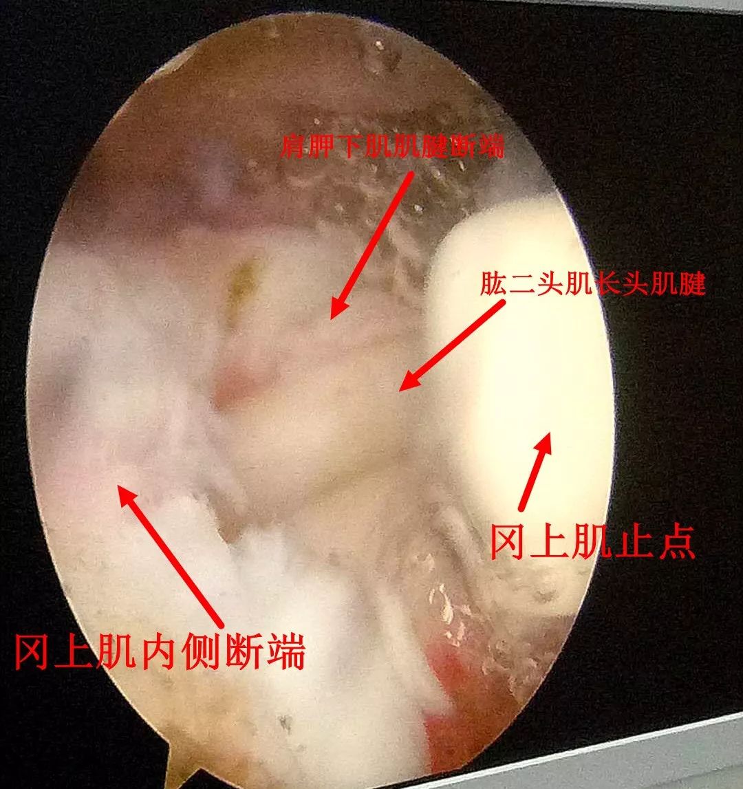 我院成功完成首例肩关节镜下肩袖损伤修复术!