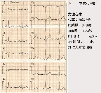 实践技能心电图满分题卡