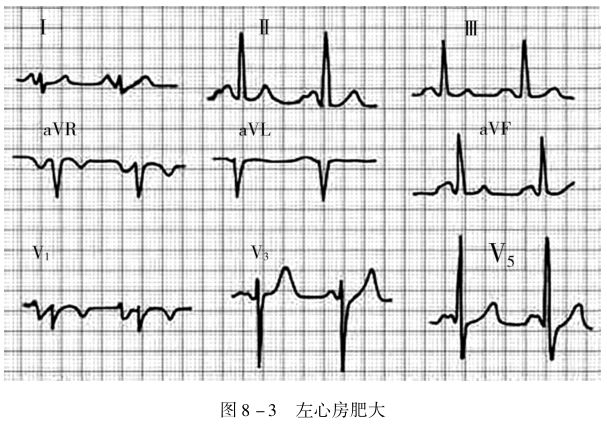 04s,以,avl导联明显,又称"二尖瓣型p波;突出表现是心房除极时间