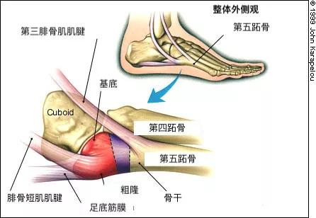 五跖骨基底部骨折)因此,崴脚这个过程中可能波及若干肌群,骨骼和韧带